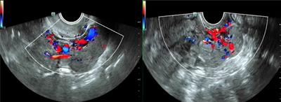 Gynecologists Need to Be Vigilant—Two Case Reports of Intravascular Leiomyomatosis and Literature Review